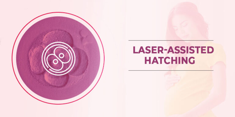 Laser Assisted Hatching
