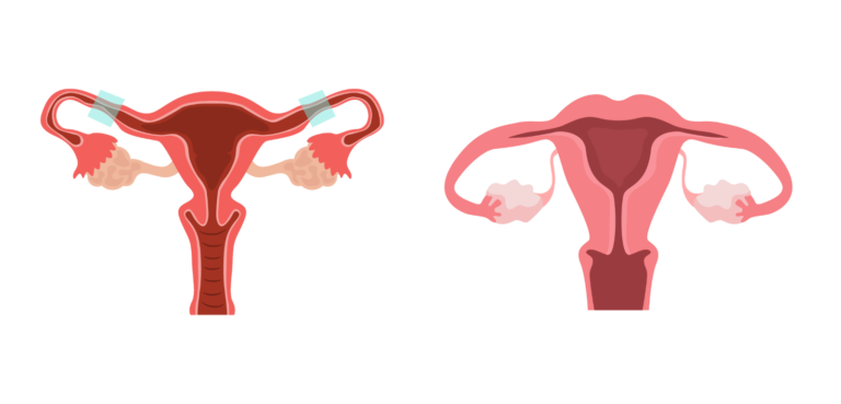 Pelvic Inflammatory Disease (PID): Causes, Symptoms & Treatment