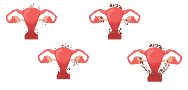 Endometriosis in Women: Symptoms, Causes & Medical Treatment