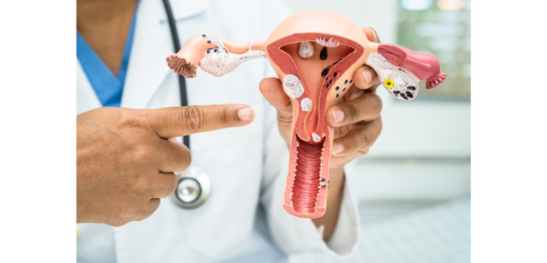 What Is Adenomyosis? Causes, Symptoms and Treatment