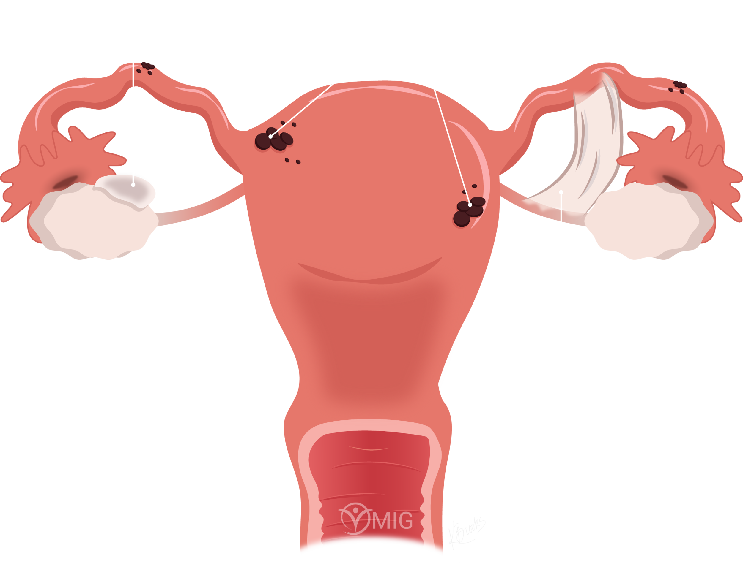 Endometriosis