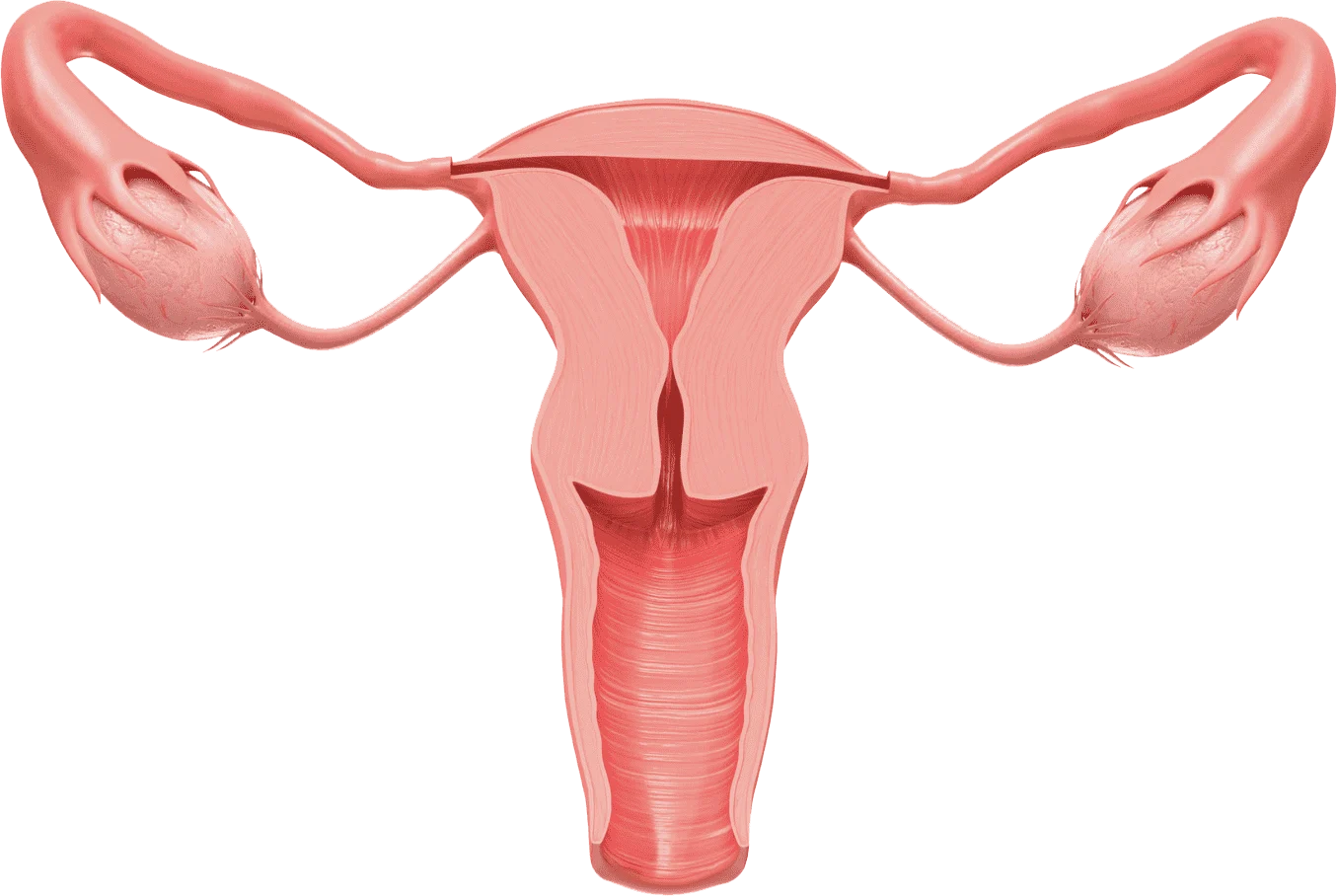 PCOS